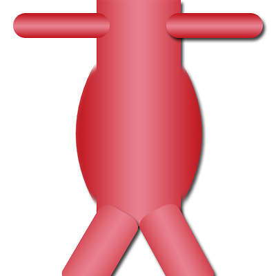 Anevrysme Aorte abdominale