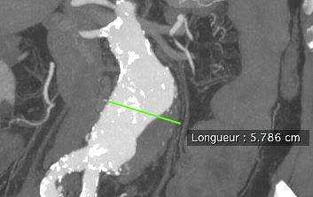 Angioscanner anevrysme de l'aorte 1