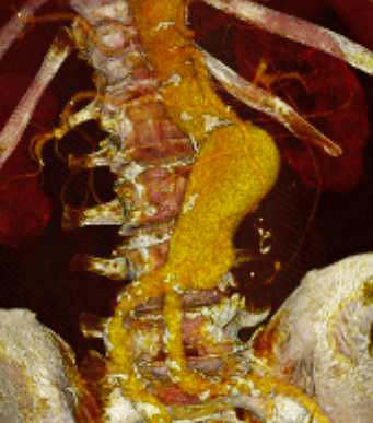 Angioscanner anevrysme de l'aorte 2