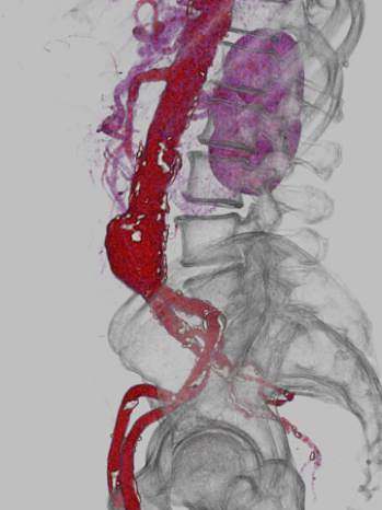 Angioscanner anevrysme de l'aorte 3