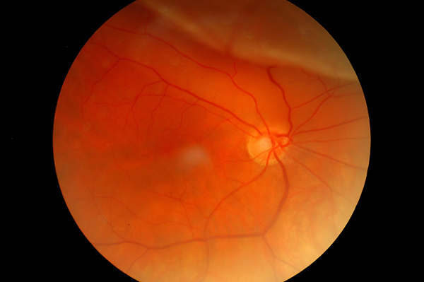 Decollement de retine 1