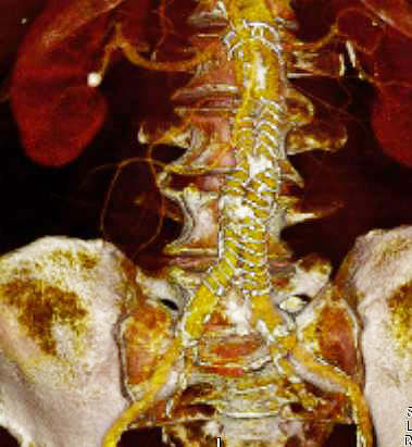 Endoprothese de l aorte abdominale 2