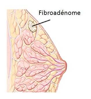 fibroadenome sein