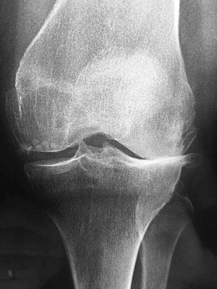 Gonarthrose femorotibiale externe