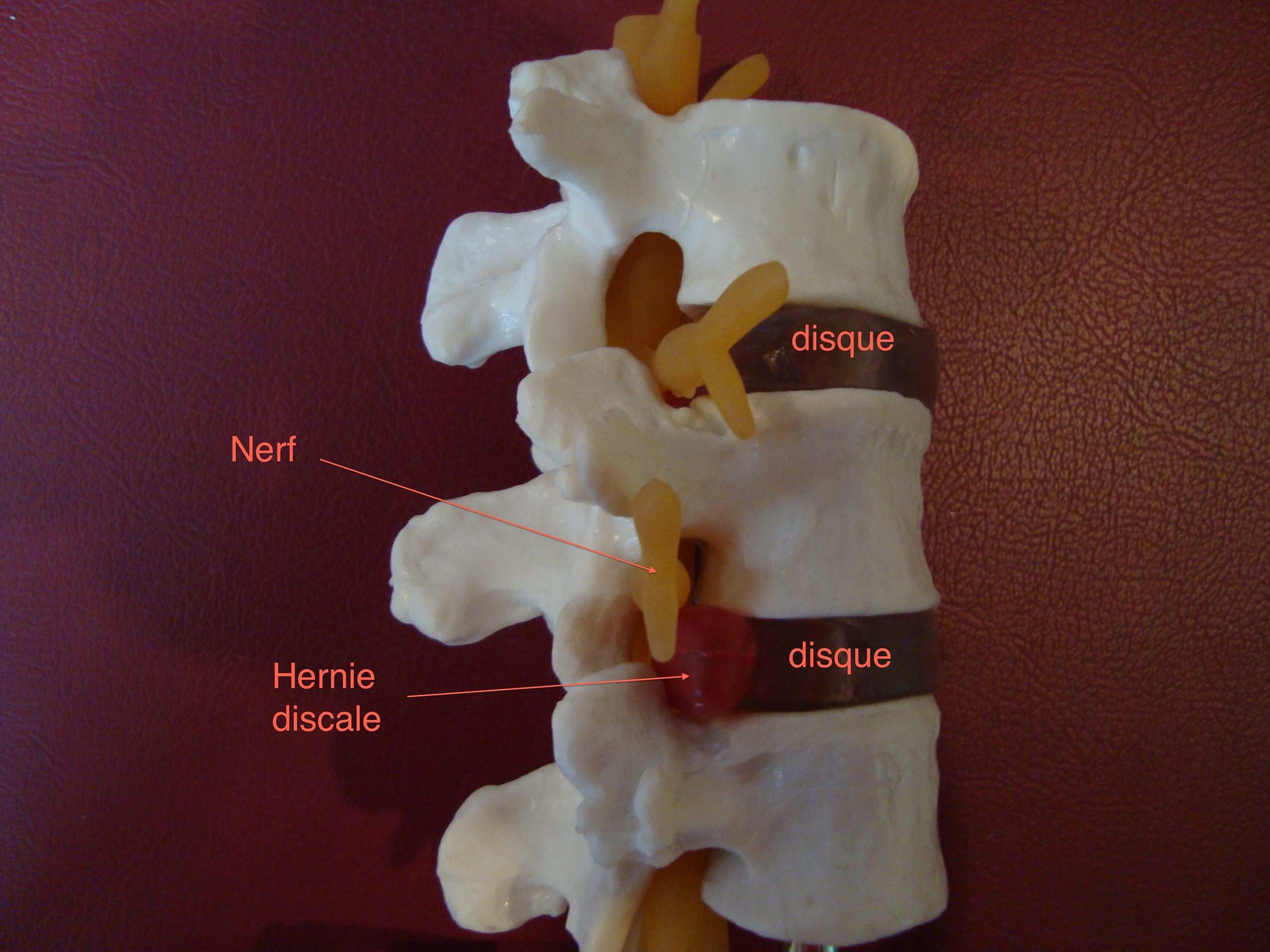 Hernie discale profil
