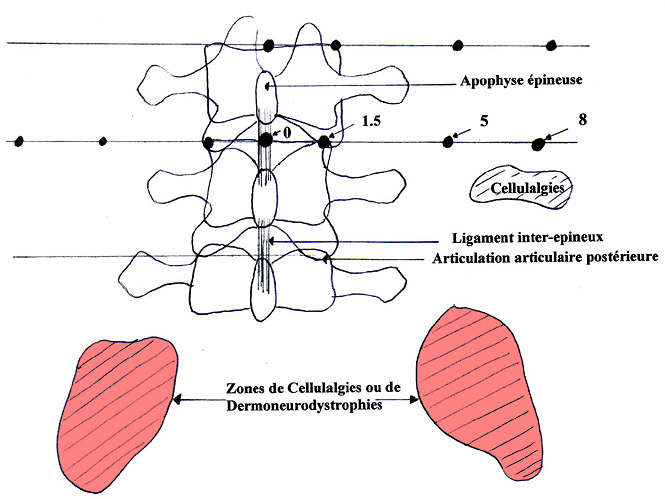 Rachis lombaire lombalgie commune