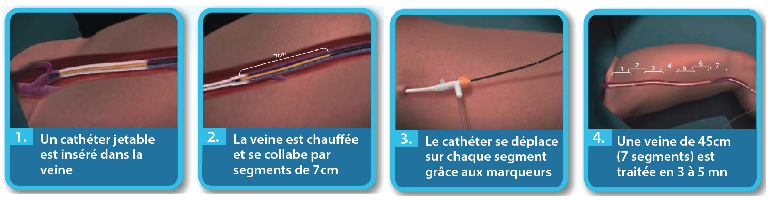 Radiofrequence Fast Closure