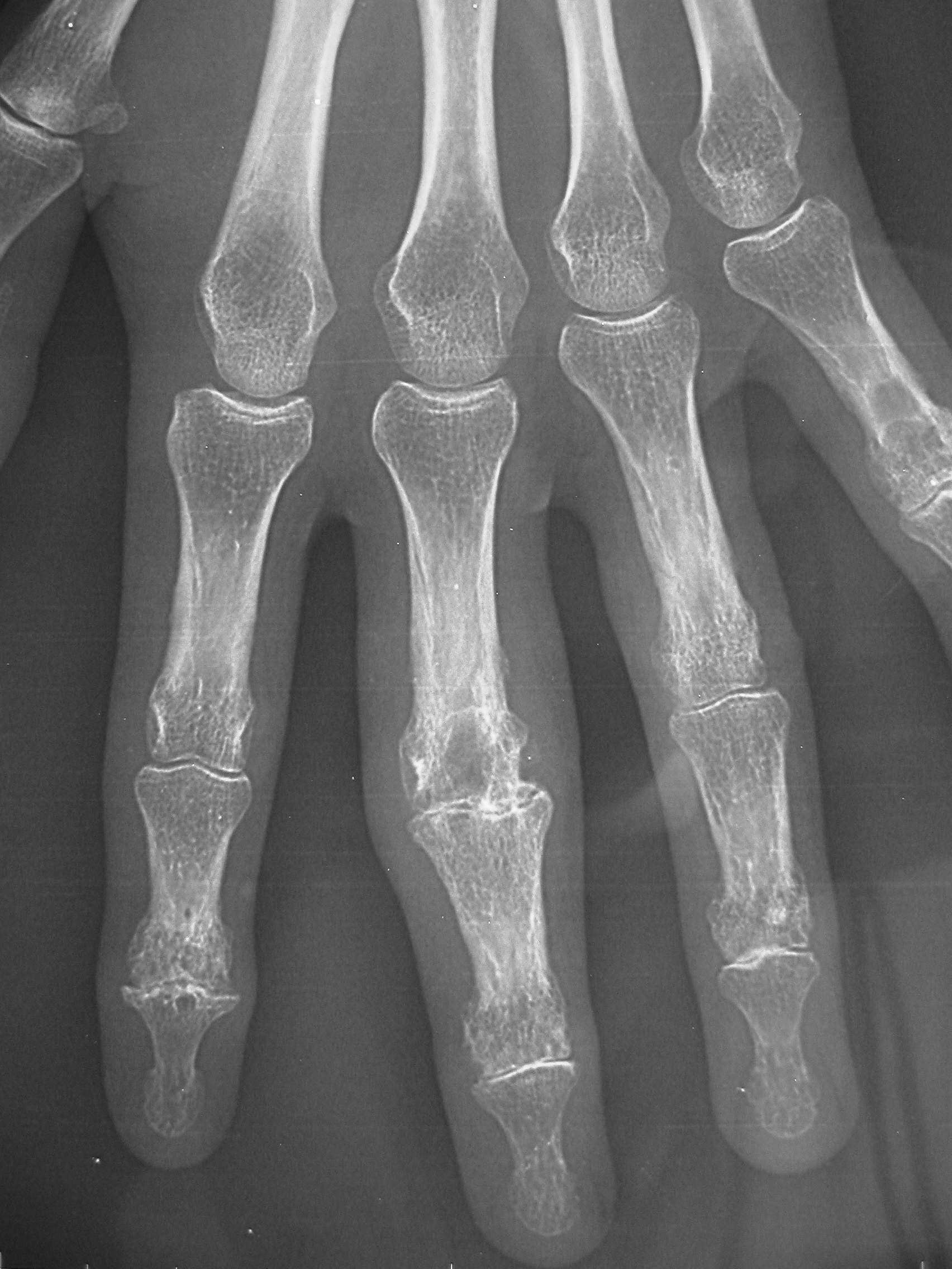 Radiographie arthrose digitale 1