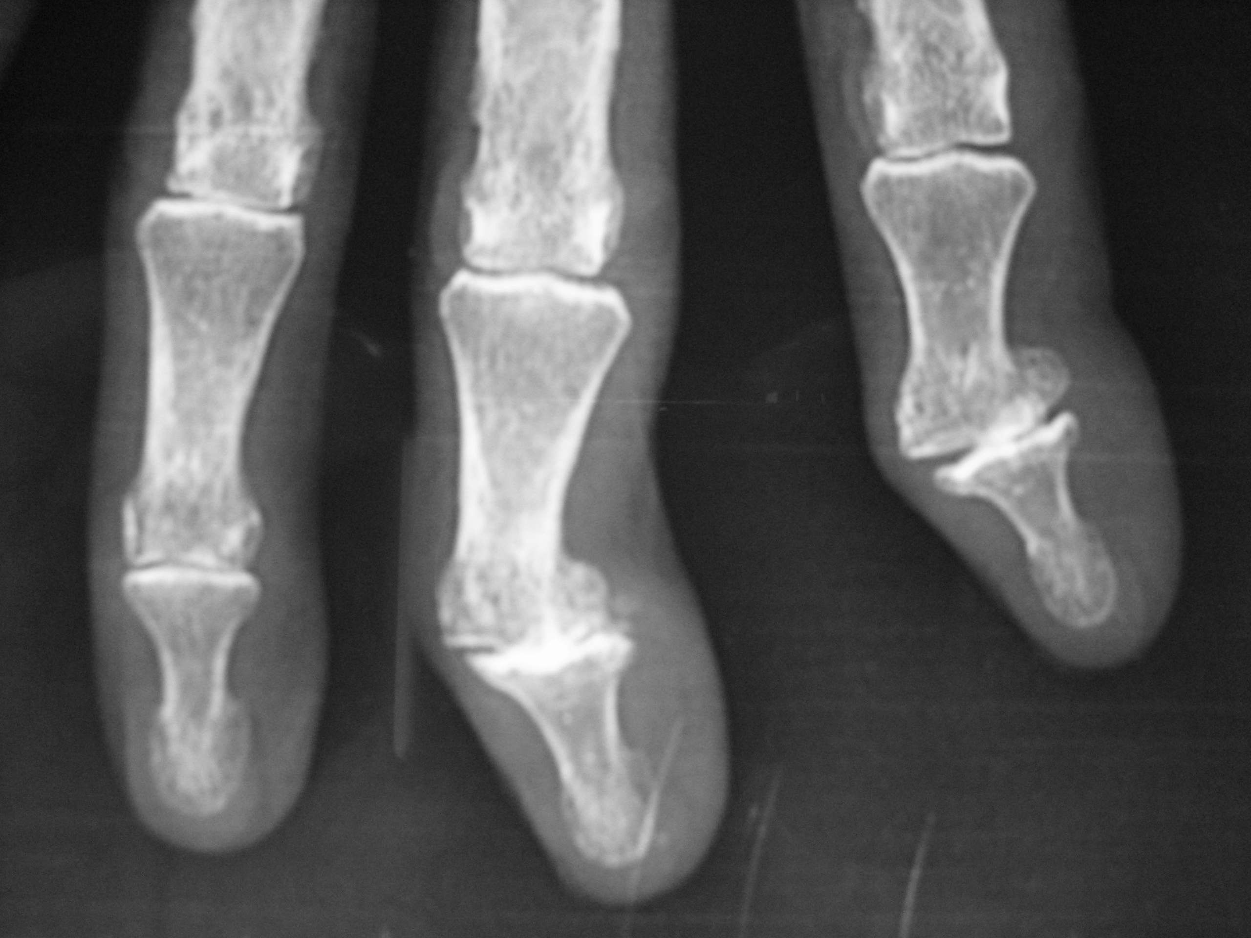 Radiographie arthrose digitale 2