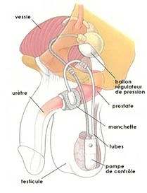 Sphincter artificiel 1