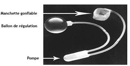 Sphincter artificiel 2